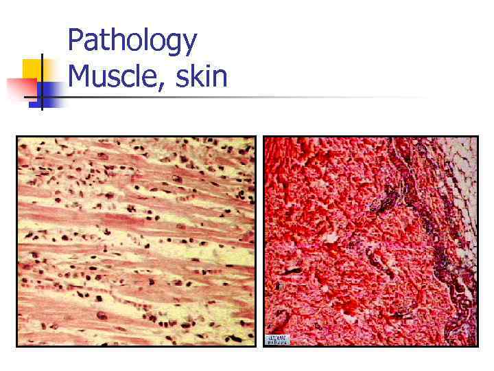 Pathology Muscle, skin 