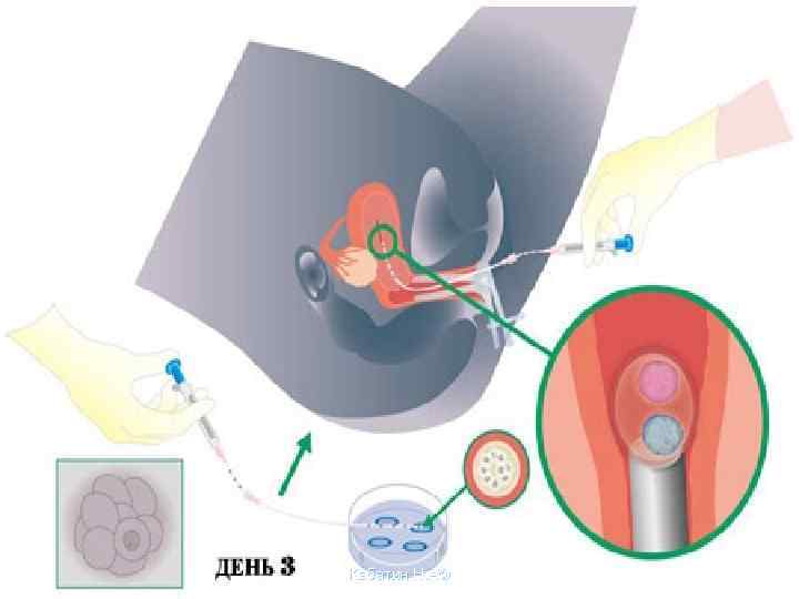 Криоперенос эмбрионов при эко