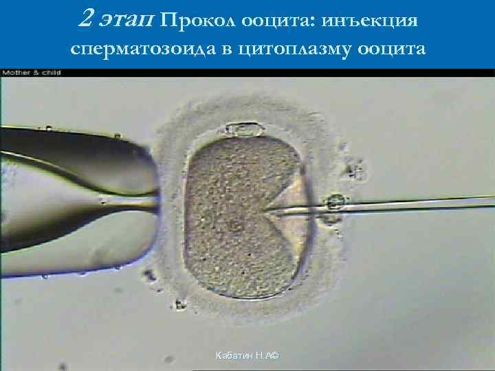 2 этап Прокол ооцита: инъекция сперматозоида в цитоплазму ооцита Кабатин Н. А© 