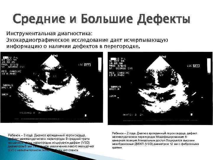 Средние и Большие Дефекты Инструментальная диагностика: Эхокардиографическое исследование дает исчерпывающую информацию о наличии дефектов