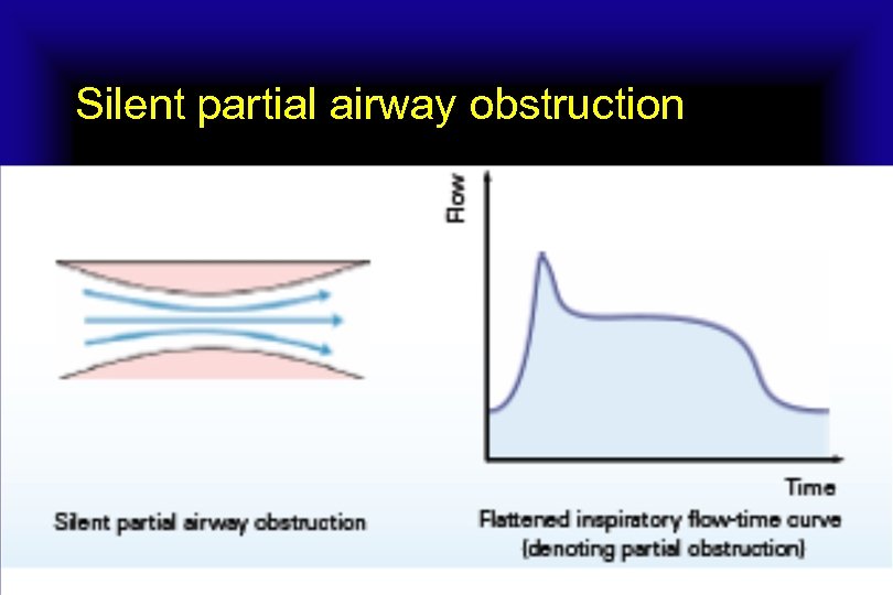 Silent partial airway obstruction 