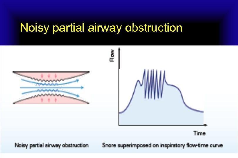 Noisy partial airway obstruction 