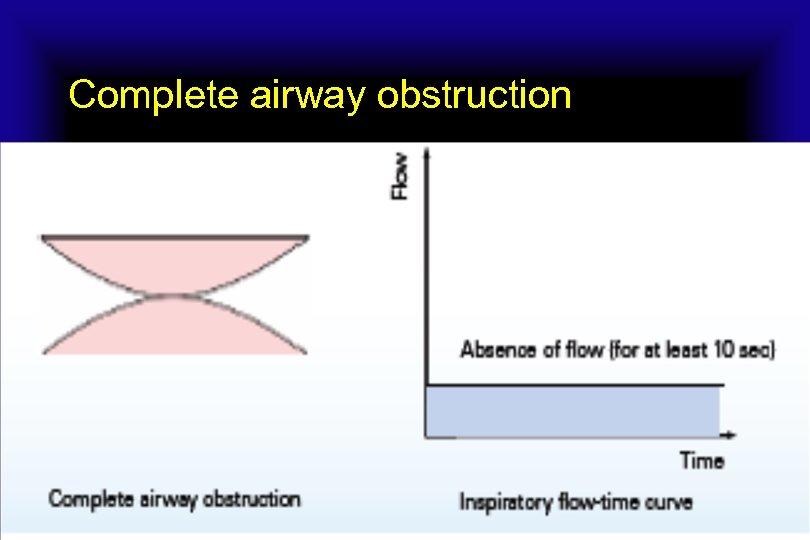 Complete airway obstruction 