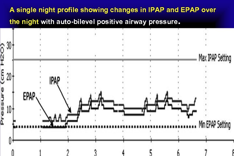 A single night profile showing changes in IPAP and EPAP over the night with
