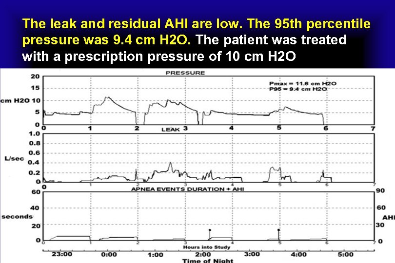 The leak and residual AHI are low. The 95 th percentile pressure was 9.