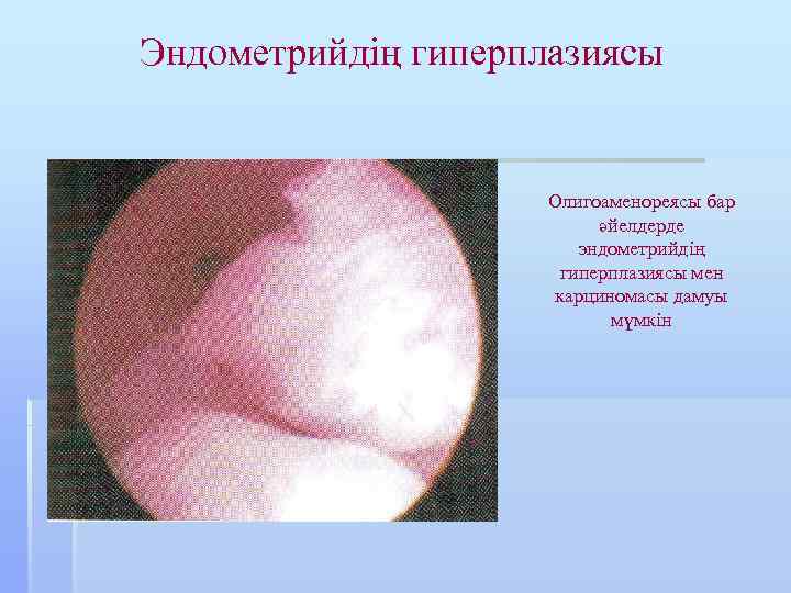 Эндометрийдің гиперплазиясы Олигоаменореясы бар әйелдерде эндометрийдің гиперплазиясы мен карциномасы дамуы мүмкін 