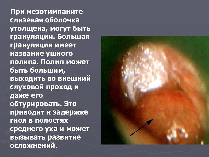 При мезотимпаните слизевая оболочка утолщена, могут быть грануляции. Большая грануляция имеет название ушного полипа.