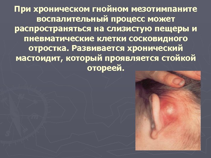 При хроническом гнойном мезотимпаните воспалительный процесс может распространяться на слизистую пещеры и пневматические клетки