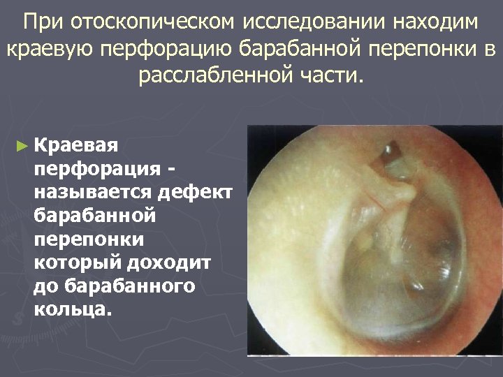 При отоскопическом исследовании находим краевую перфорацию барабанной перепонки в расслабленной части. ► Краевая перфорация
