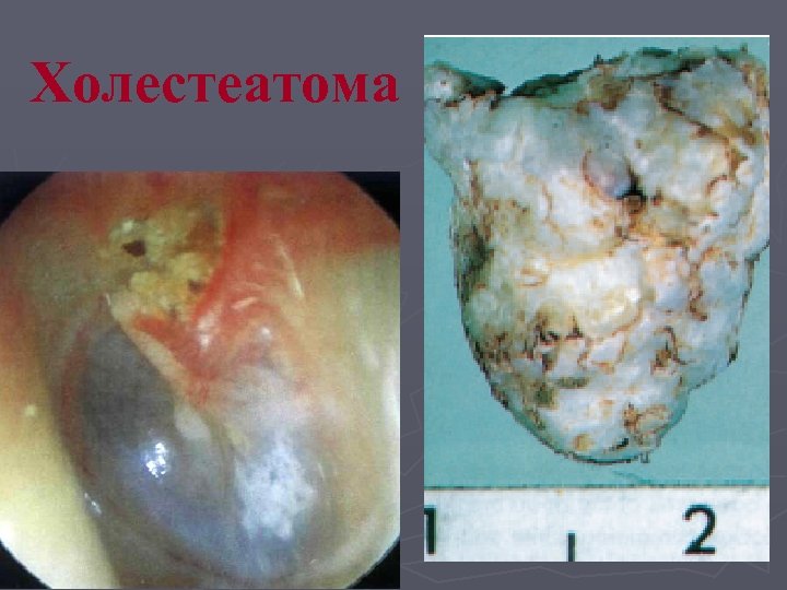 Xoлестеатома 