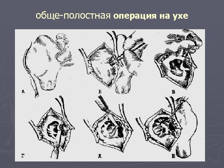 обще-полостная операция на ухе 
