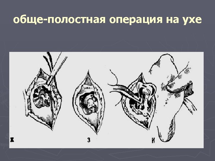 обще-полостная операция на ухе 