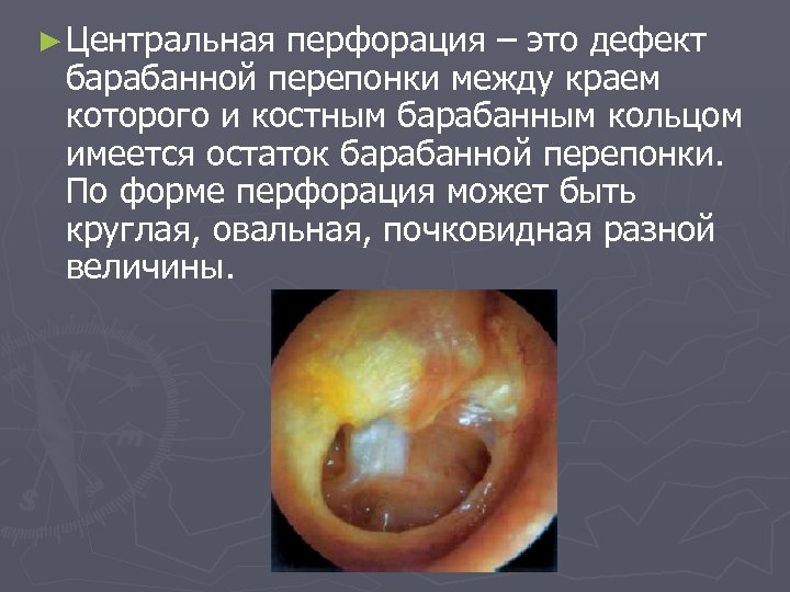 ► Центральная перфорация – это дефект барабанной перепонки между краем которого и костным барабанным
