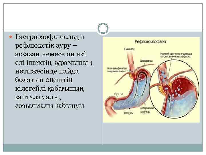  Гастроэзофагеальды рефлюкстік ауру – асқазан немесе он екі елі ішектің құрамының нәтижесінде пайда