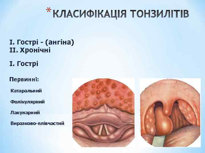 * І. Гострі - (ангіна) ІІ. Хронічні І. Гострі Первинні: Катаральний Фолікулярний Лакунарний Виразково-плівчастий