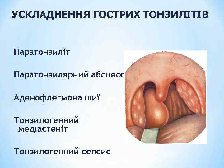 УСКЛАДНЕННЯ ГОСТРИХ ТОНЗИЛІТІВ Паратонзиліт Паратонзилярний абсцесс Аденофлегмона шиї Тонзилогенний медіастеніт Тонзилогенний сепсис 