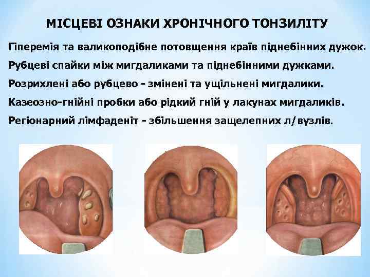 МІСЦЕВІ ОЗНАКИ ХРОНІЧНОГО ТОНЗИЛІТУ Гіперемія та валикоподібне потовщення країв піднебінних дужок. Рубцеві спайки між