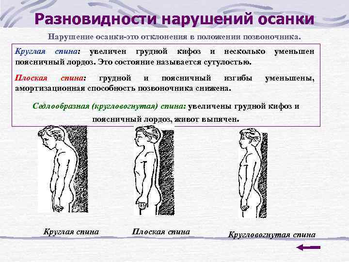 Как называют нарушение осанки изображенное на рисунке 3 сформулируйте правило