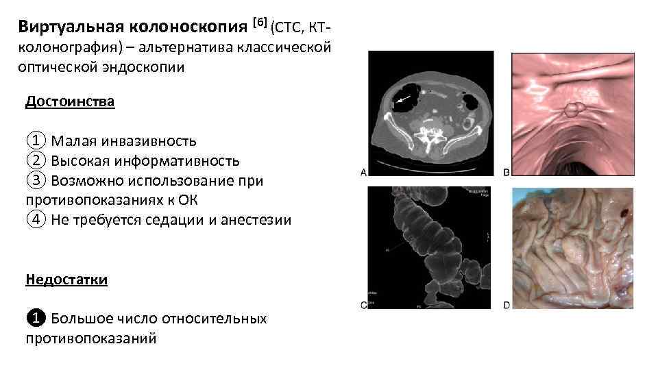 Виртуальная колоноскопия [6] (СТС, КТ- колонография) – альтернатива классической оптической эндоскопии Достоинства ① Малая