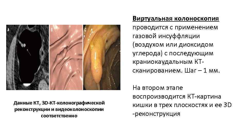 Виртуальная колоноскопия проводится с применением газовой инсуффляции (воздухом или диоксидом углерода) с последующим краниокаудальным
