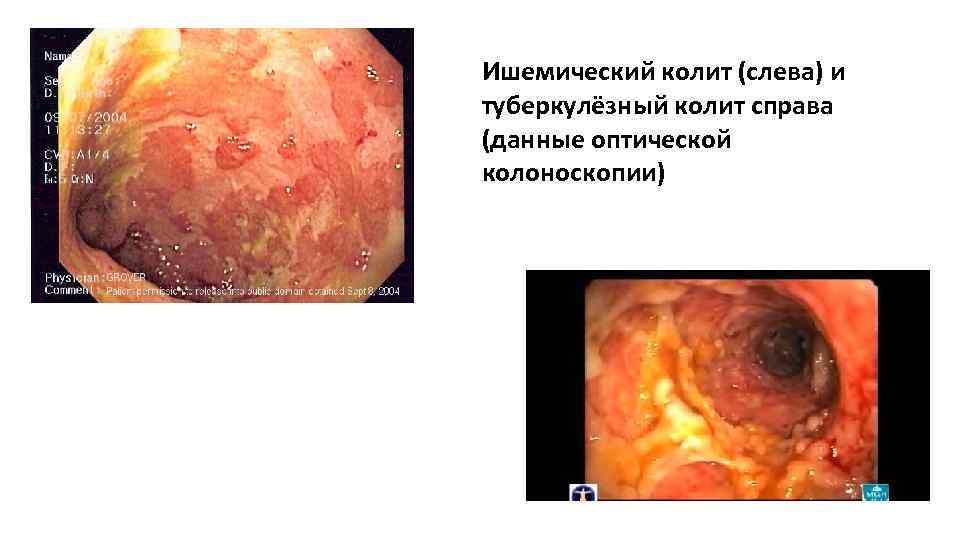 Ишемический колит (слева) и туберкулёзный колит справа (данные оптической колоноскопии) 
