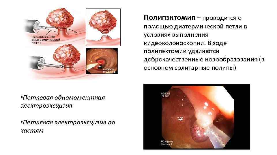 Полипэктомия – проводится с помощью диатермической петли в условиях выполнения видеоколоноскопии. В ходе полипэктомии
