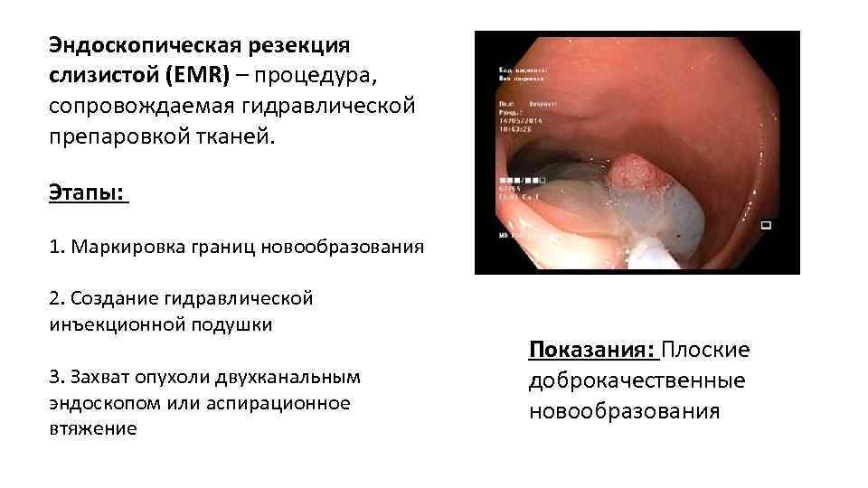 Эндоскопическая резекция слизистой (EMR) – процедура, сопровождаемая гидравлической препаровкой тканей. Этапы: 1. Маркировка границ