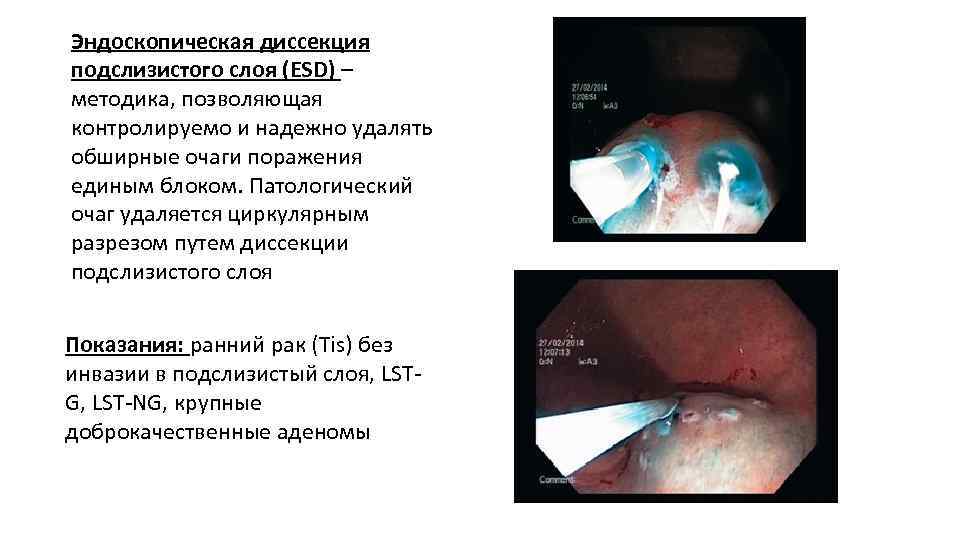 Эндоскопическая диссекция подслизистого слоя (ESD) – методика, позволяющая контролируемо и надежно удалять обширные очаги