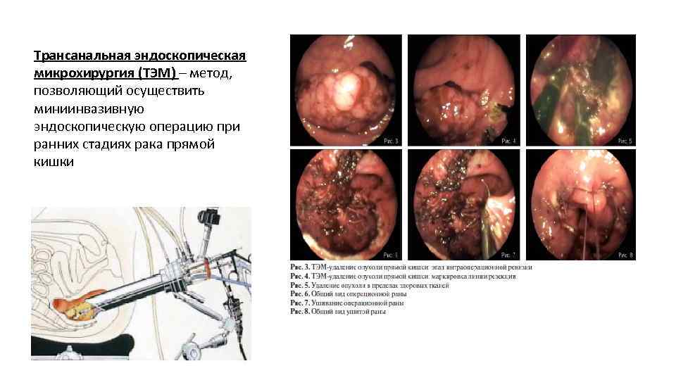 Трансанальная эндоскопическая микрохирургия (ТЭМ) – метод, позволяющий осуществить миниинвазивную эндоскопическую операцию при ранних стадиях