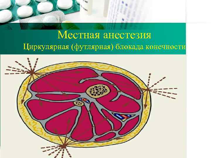 Местная анестезия Циркулярная (футлярная) блокада конечности 