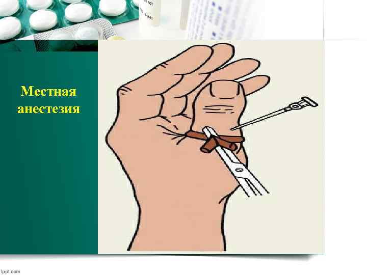 Местная анестезия 