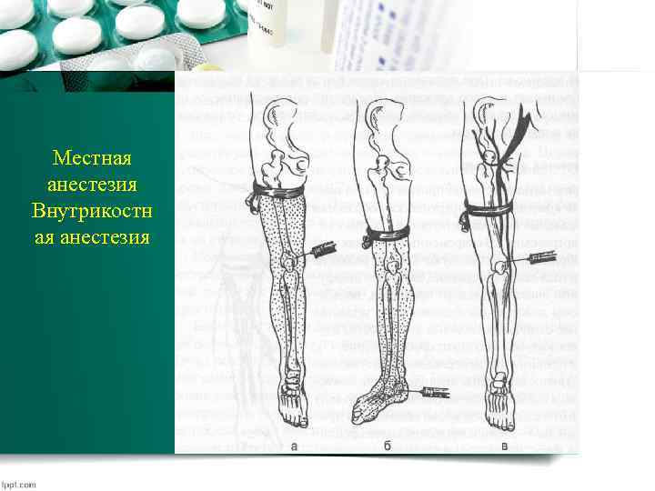 Местная анестезия Внутрикостн ая анестезия 