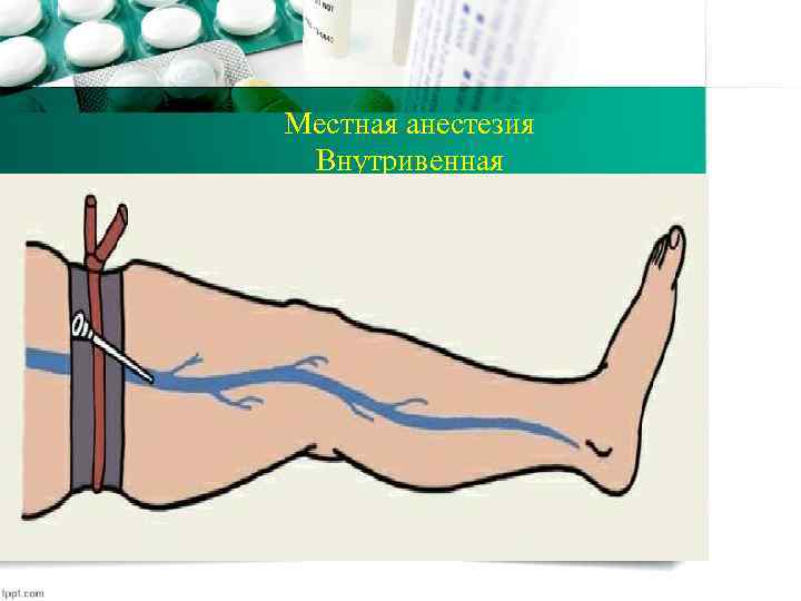 Местная анестезия Внутривенная 