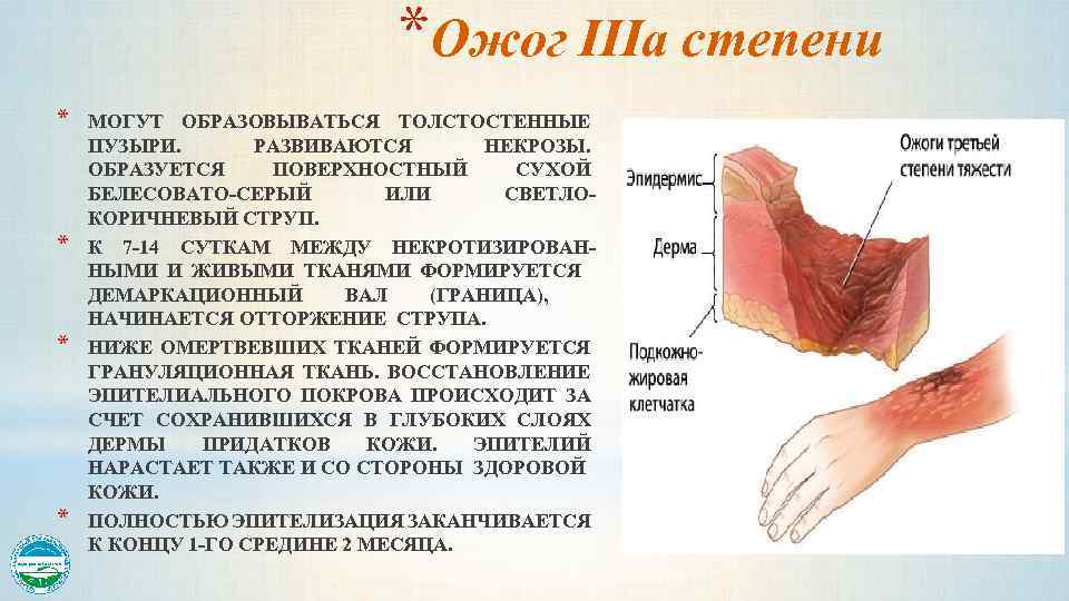 *Ожог IIIа степени * * МОГУТ ОБРАЗОВЫВАТЬСЯ ТОЛСТОСТЕННЫЕ ПУЗЫРИ. РАЗВИВАЮТСЯ НЕКРОЗЫ. ОБРАЗУЕТСЯ ПОВЕРХНОСТНЫЙ СУХОЙ