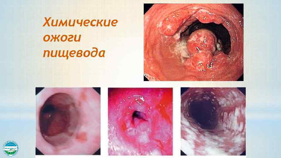 Химические ожоги пищевода 