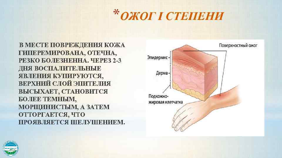 *ОЖОГ I СТЕПЕНИ В МЕСТЕ ПОВРЕЖДЕНИЯ КОЖА ГИПЕРЕМИРОВАНА, ОТЕЧНА, РЕЗКО БОЛЕЗНЕННА. ЧЕРЕЗ 2 -3