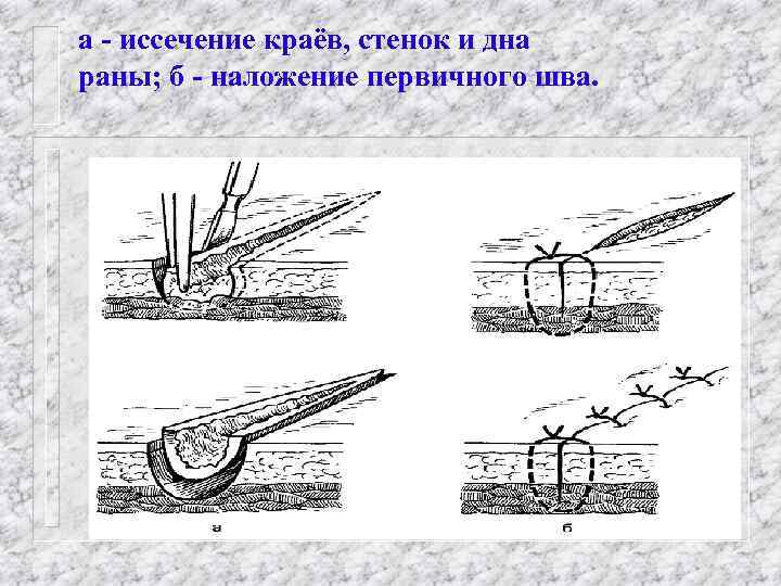 а - иссечение краёв, стенок и дна раны; б - наложение первичного шва. 