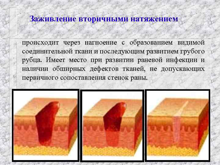 Заживление вторичными натяжением происходит через нагноение с образованием видимой соединительной ткани и последующим развитием