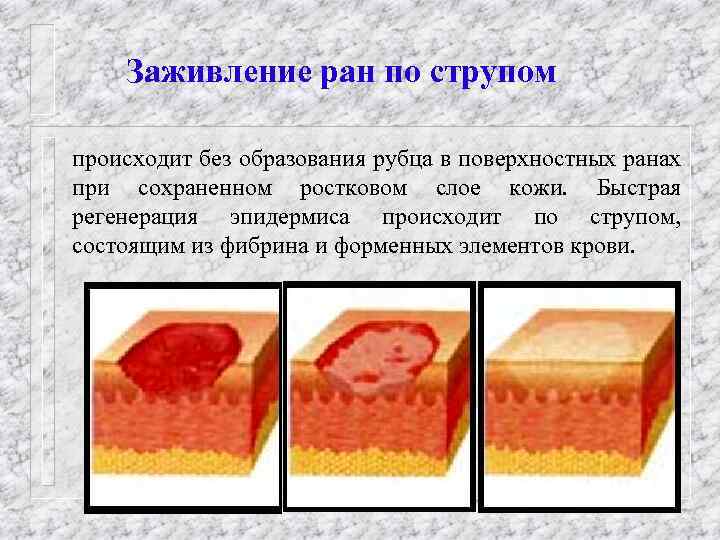 Заживление ран по струпом происходит без образования рубца в поверхностных ранах при сохраненном ростковом