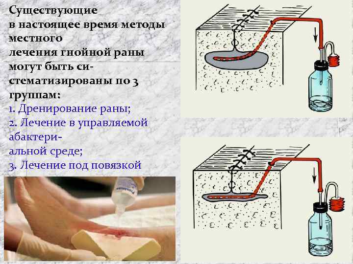 Существующие в настоящее время методы местного лечения гнойной раны могут быть систематизированы по 3