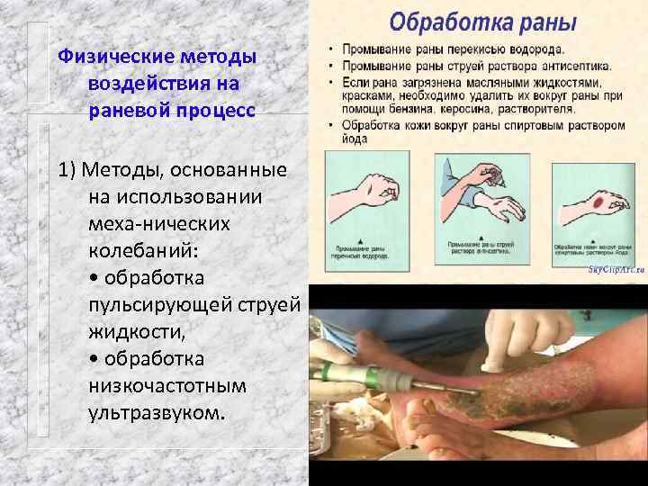 Физические методы воздействия на раневой процесс 1) Методы, основанные на использовании меха нических колебаний: