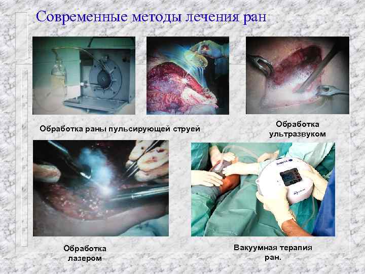 Современные методы лечения ран: Обработка раны пульсирующей струей Обработка лазером Обработка ультразвуком Вакуумная терапия
