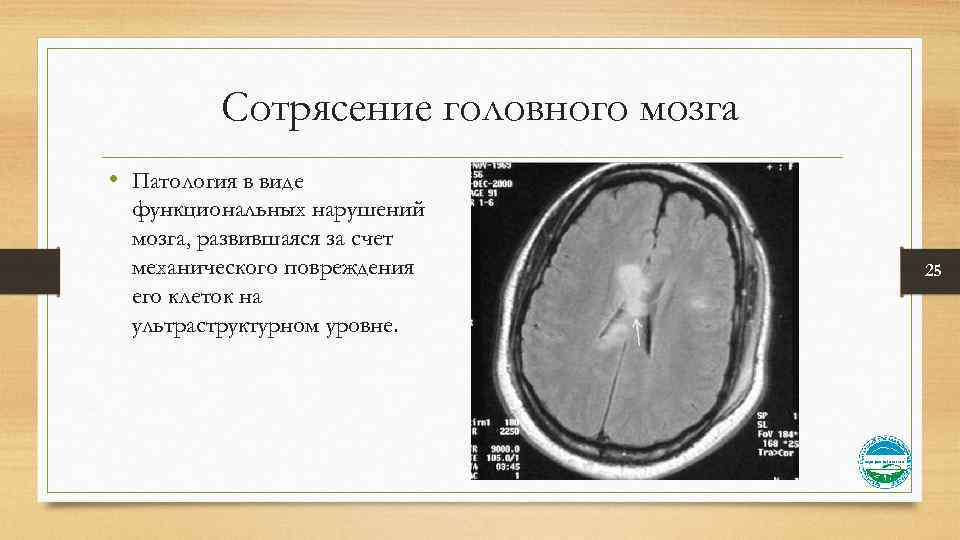 Сотрясение головного мозга • Патология в виде функциональных нарушений мозга, развившаяся за счет механического