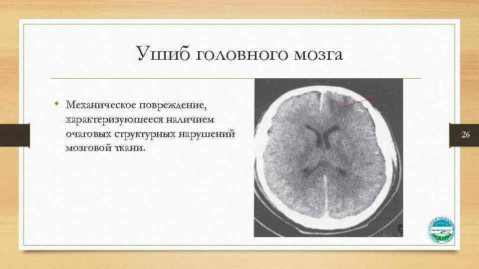 Ушиб головного мозга • Механическое повреждение, характеризующееся наличием очаговых структурных нарушений мозговой ткани. 26