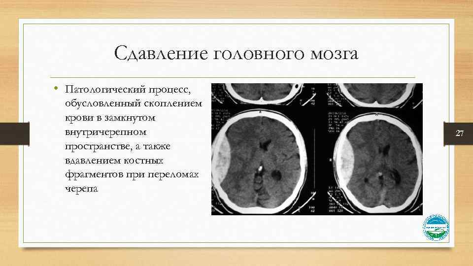 Сдавление головного мозга • Патологический процесс, обусловленный скоплением крови в замкнутом внутричерепном пространстве, а