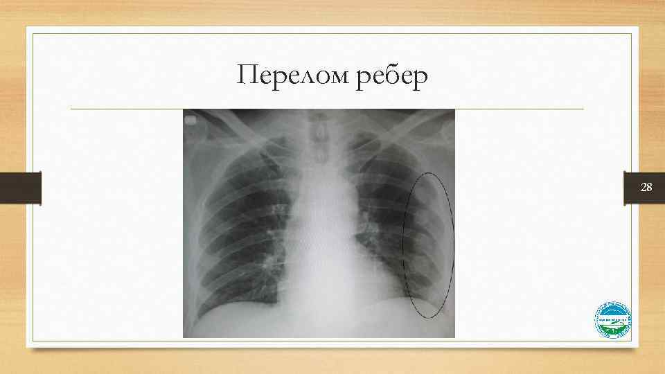 Перелом ребер 28 