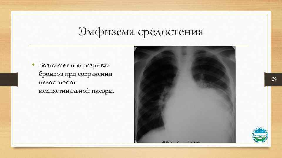 Эмфизема средостения • Возникает при разрывах бронхов при сохранении целостности медиастинальной плевры. 29 