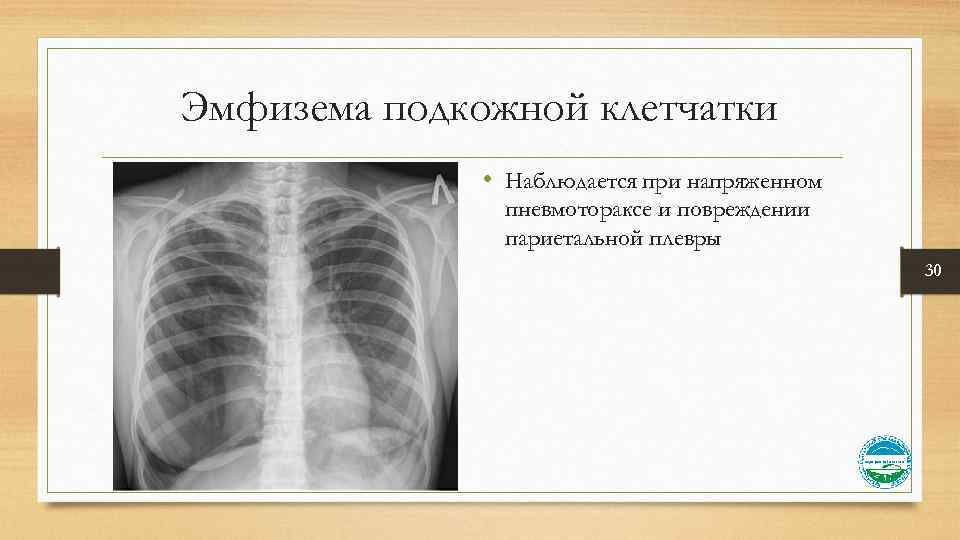 Эмфизема подкожной клетчатки • Наблюдается при напряженном пневмотораксе и повреждении париетальной плевры 30 