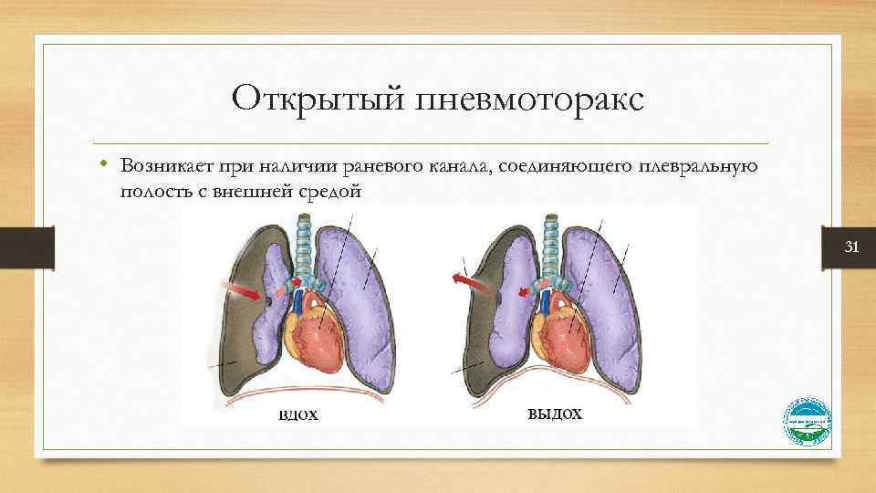 Открытый пневмоторакс • Возникает при наличии раневого канала, соединяющего плевральную полость с внешней средой