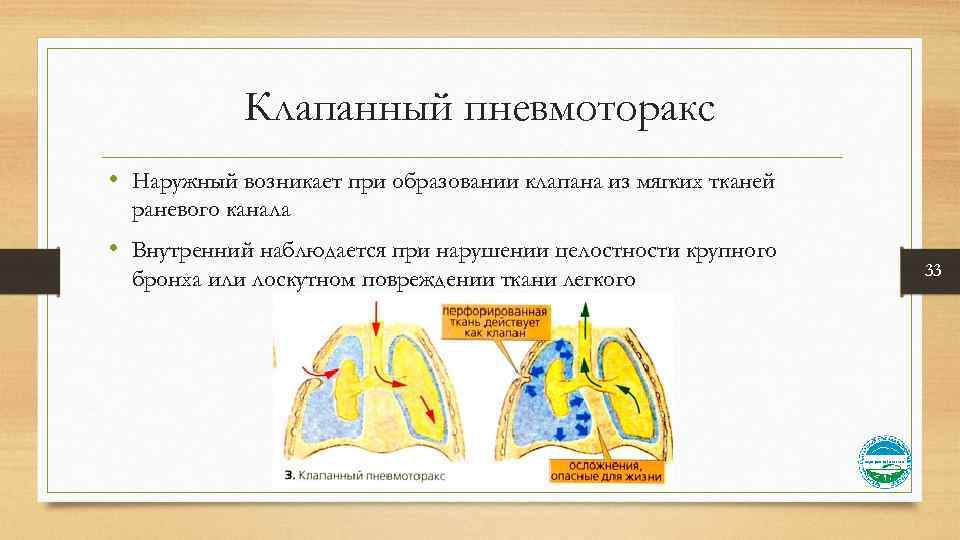 Клапан при пневмотораксе